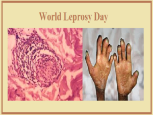 Embracing Hope and Combating Stigma: World Leprosy Day